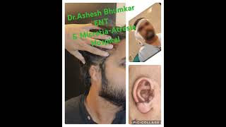 MicrotiaAtresia Surgery Pinnaplasty using costal cartilage [upl. by Ahsinoj798]