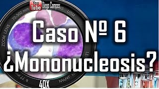 caso clinico Nº 6  Mononucleosis infecciosa [upl. by Alcock767]