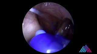 Eustachian tube balloon dilation for eustachian tube dysfunction [upl. by Dionysus]