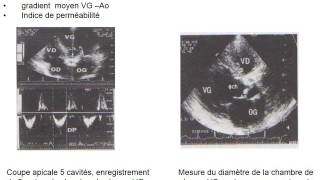 CARDIOLOGIE RÉTRÉCISSEMENT AORTIQUE [upl. by Enihsnus]