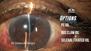 Secondary IOL implantation in an aphakic eye with PC tear amp vitreous prolapse Dr Deepak Megur [upl. by Aeht]