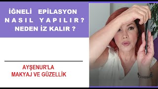 İğneli Epilasyon Nasıl yapılır  Neden İz kalır  Doğrusu Nedir [upl. by Thay]