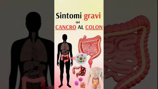 Sintomi gravi del cancro al colon [upl. by Rebecka206]