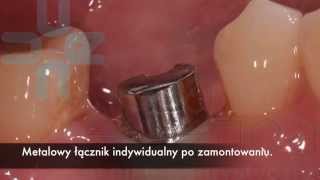 Korony porcelanowe mocowane na implantach [upl. by Ennyrb342]