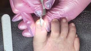 Toenail reconstruction on damaged nail [upl. by Anen]