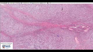 Testis Seminoma  Microscopy Talking slide [upl. by Karissa]