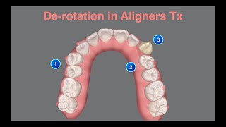 Derotation in Aligners Tx｜【Chris Chang Ortho】CC761 [upl. by Htennek]