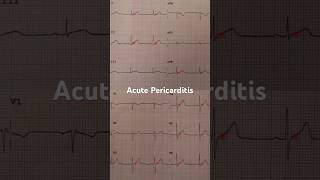 Acute Pericarditis ECG Example 2 [upl. by Ssew]