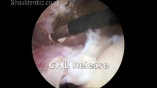 Cuff Releases  anterior and CHL  viewing from posterior and working from lateral  labelsmov [upl. by Gerge]