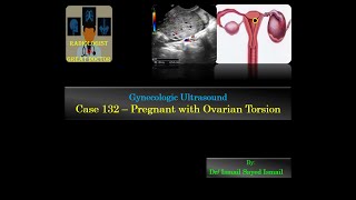 Ultrasound Case 132  Pregnant with Ovarian Torsion [upl. by Acile398]