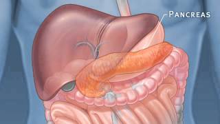 Pancreatic Auto Islet Transplantation with Total Pancreatectomy [upl. by Ahsiem682]