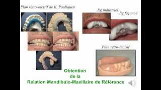 Relation Mandibulo Maxillaire Référence en Prothèse wmv [upl. by Nesta]