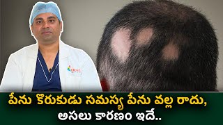 Alopecia areata Symptoms Causes and Treatment  Treatment for Alopecia Areata  Hair Loss treatment [upl. by Llered]