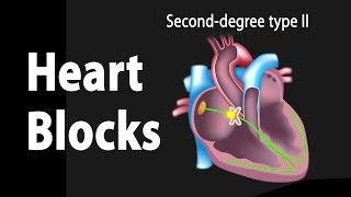 Intro to EKG Interpretation  Bundle Branch Blocks [upl. by Eelik6]