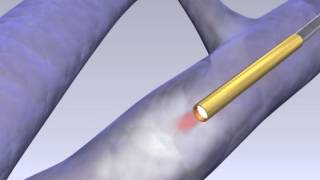 VenaCure EVLT Laser Vein Treatment with the NeverTouch Fibre [upl. by Eimyaj]