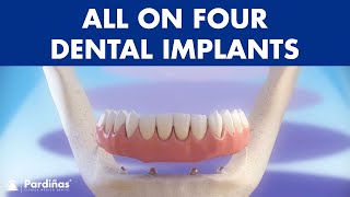 All on 4 dental implant treatment  Fixed denture © [upl. by Anigroeg686]