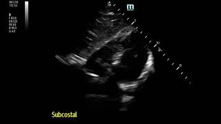 Severe Pleuritic MidChest Pain in 17 yo Boy Pneumomediastinum [upl. by Beitnes971]