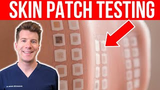 ALLERGY TESTING Doctor explains the Skin Patch Test [upl. by Aliuqat855]