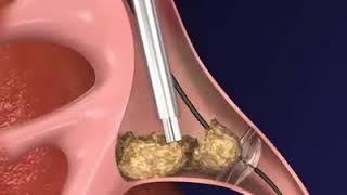 Cystoscopic Laser Lithotripsy and Stone Extraction Cystolithalopaxy [upl. by Nikaniki]