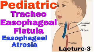 Tracheoesophageal fistula in hindiEsophageal Atresia  TEF EA  staff nurse online classes [upl. by Alanah]