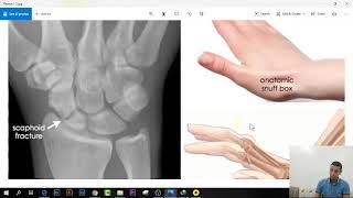 شرح كل كسور استقبال العظام فى ساعتين  16 Scaphoid Fracture [upl. by Einnel]