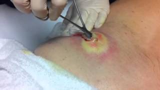 Lancing infected cyst  abscess [upl. by Enitsua]