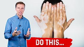 Vitiligo Do These 3 Things [upl. by Sharl]