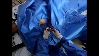 PTGBD insertion Cholecystostomy tube insertion 경피적 담낭조루술 [upl. by Jeuz]