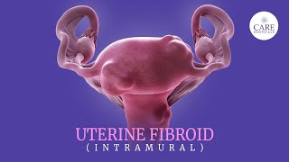 Uterine fibroids 5 signs you should never ignore  Treatment Options for Uterine Fibroids [upl. by Lajes]