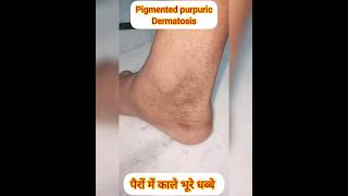 पैरों में काले भूरे धब्बे SCHAMBERG DISEASE pigmentation purpura shortsfeed shortvideo shorts [upl. by Perretta]