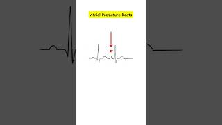 Premature Atrial Contractions Atrial Couplets medicine doctor cardiology medicalstudent ecg [upl. by Odraccir]