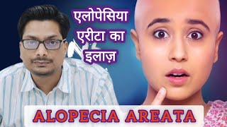 एलोपेसिया एरीटा का इलाज़  Alopecia Areata  बालों के गंजापन का इलाज़  Hairfall Treatment alopecia [upl. by Rehpotsrihc]