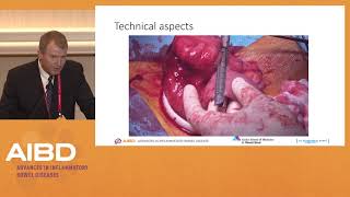 IBD Surgery Debate 1 Ileocecal Crohns disease [upl. by Adnahcal]