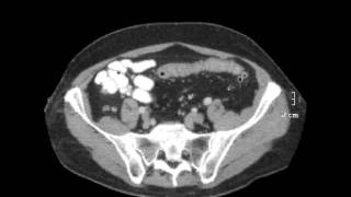 colon Carcinoma [upl. by Kolnos]