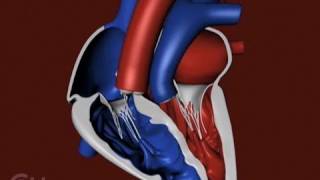 The Structure of a Heart with Transposition of the Great Arteries TGA  CHOP [upl. by Nylkoorb280]