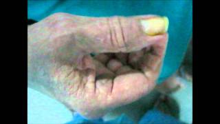 PillRolling Tremors In Parkinsons Disease [upl. by Tiffany415]