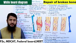 Repair of broken bones  Bone fractures  Healing process of a simple fracture  Class 12 [upl. by Dnomsed834]