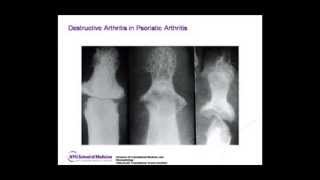 NYU Advanced Rheumatology Board Review Course Preview [upl. by Enimisaj]