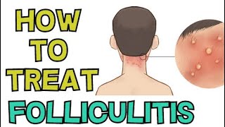 HOW TO TREAT FOLLICULITIS FAST [upl. by Nicoline]