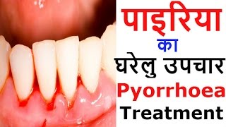 पायरिया के घरेलू उपाय और नुस्खे  Natural Home Remedies amp Treatment for Pyorrhea [upl. by Bondy272]