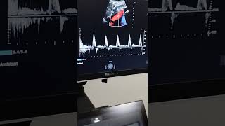 PRACTICA ECO DOPPLER ABDOMINAL [upl. by Gereron]