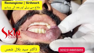 Haemangioma  birthmark treatment with laser  Dermatologist  Dr Bilal Shams skincenterpakistan [upl. by Erual]