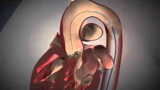 Fluoroscopy and Animation of the TAVI Procedure  NEJM [upl. by Nuahsal410]