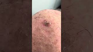 حالة تقران سفعى Actinic Keratosis [upl. by Agni]