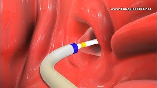 Balloon Eustachian Tube Dilation to Treat Eustachian Tube Dysfunction [upl. by Daye]