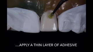 Porcelain Veneer Cementation step by step technique [upl. by Androw]