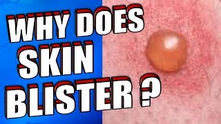 Why Does Skin Blister  How To Treat amp Prevent Skin Blisters Naturally [upl. by Lehplar]