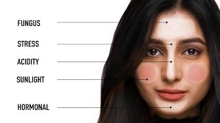 What Your Pimples Say About Your Health  Face Mapping with Dermatologist Bindu Sthalekar [upl. by Atnoled]