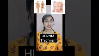 HERNIA Part 3 Must watch all 3 parts to know everything about Hernia doctor new hernia [upl. by Ycnalc]