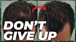 5 Finasteride Alternatives  Watch This if You CANT Use Finasteride [upl. by Lammaj]